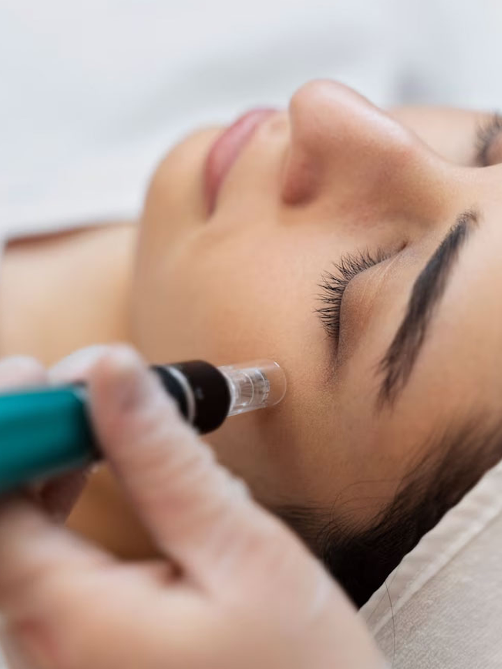 microneedling-1