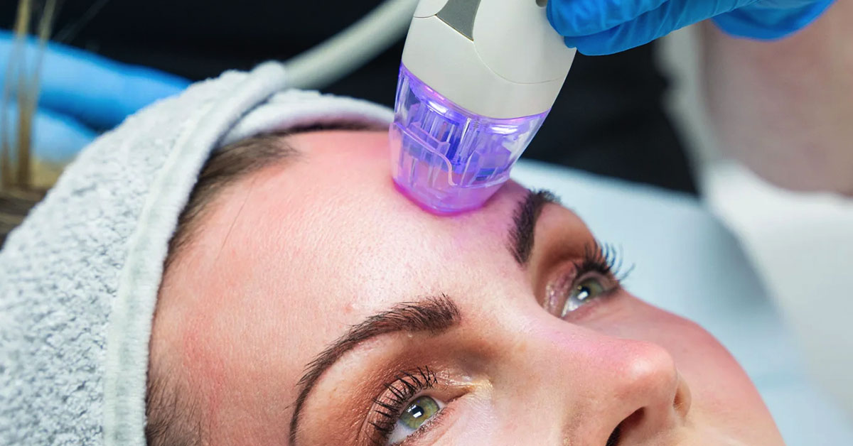 rfmicroneedling